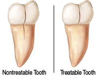 Cracked Tooth | Waterfront Endodontics