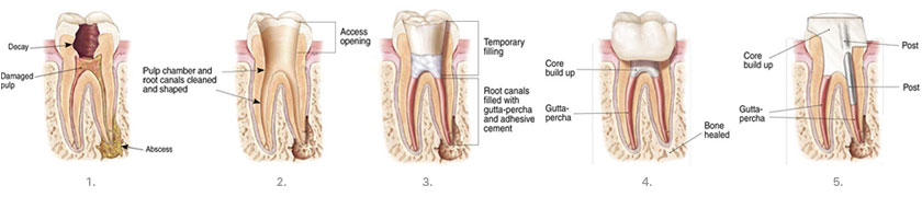 Root Canal Therapy | Waterfront Endodontics